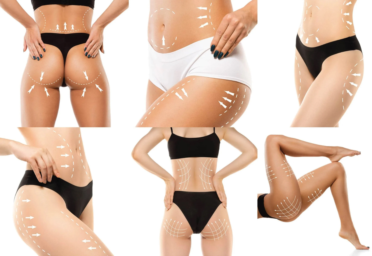 Bodyforming mit LIPOSANA3 Medically Beauty