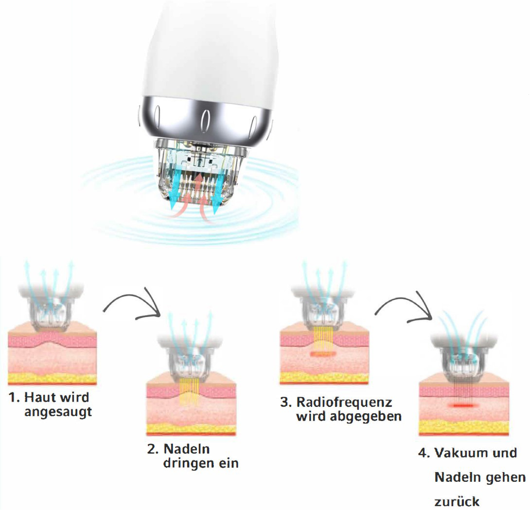 Micro-Needeling mit Radiofrequenz in München