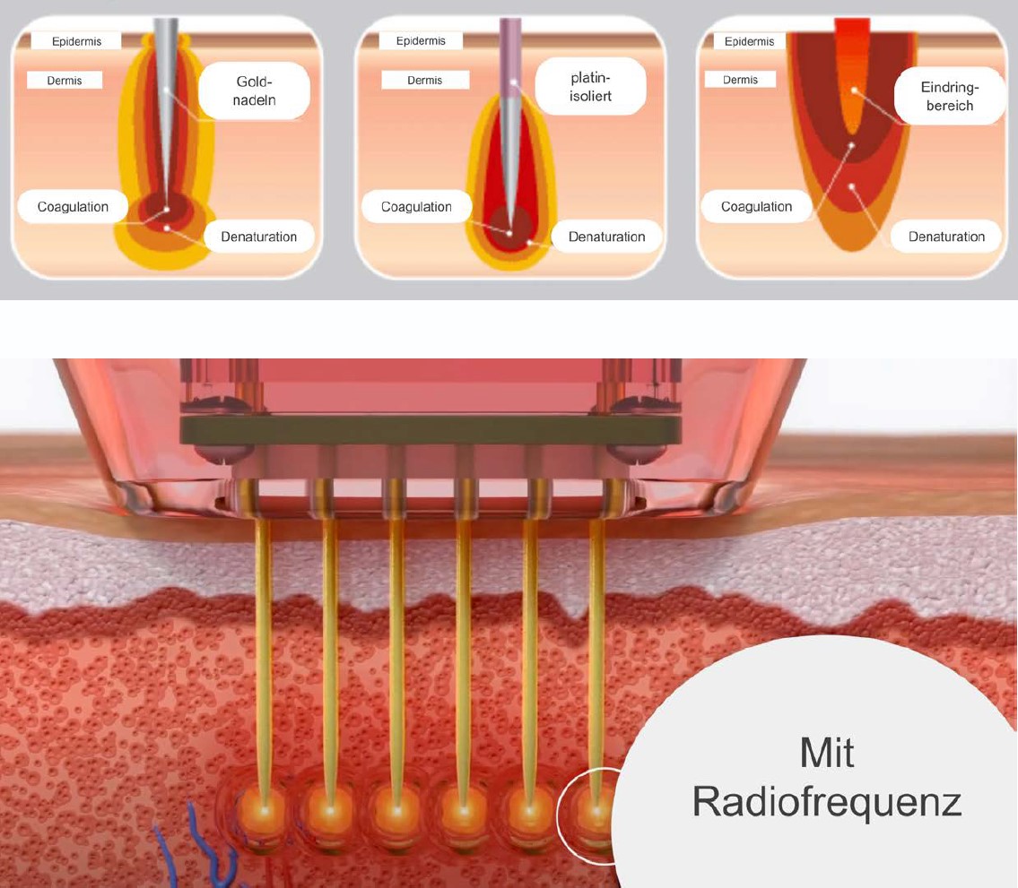 Micro-Needeling mit Radiofrequenz in München